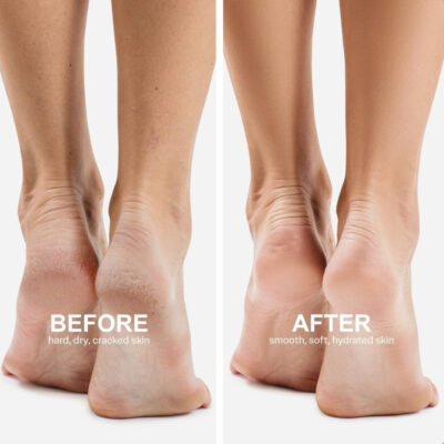 Ενυδατικές κάλτσες για τις φτέρνες με Νιασιναμίδη